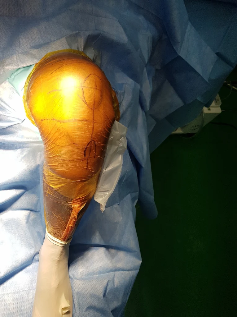 Knee prepared for an orthopaedic surgical procedure