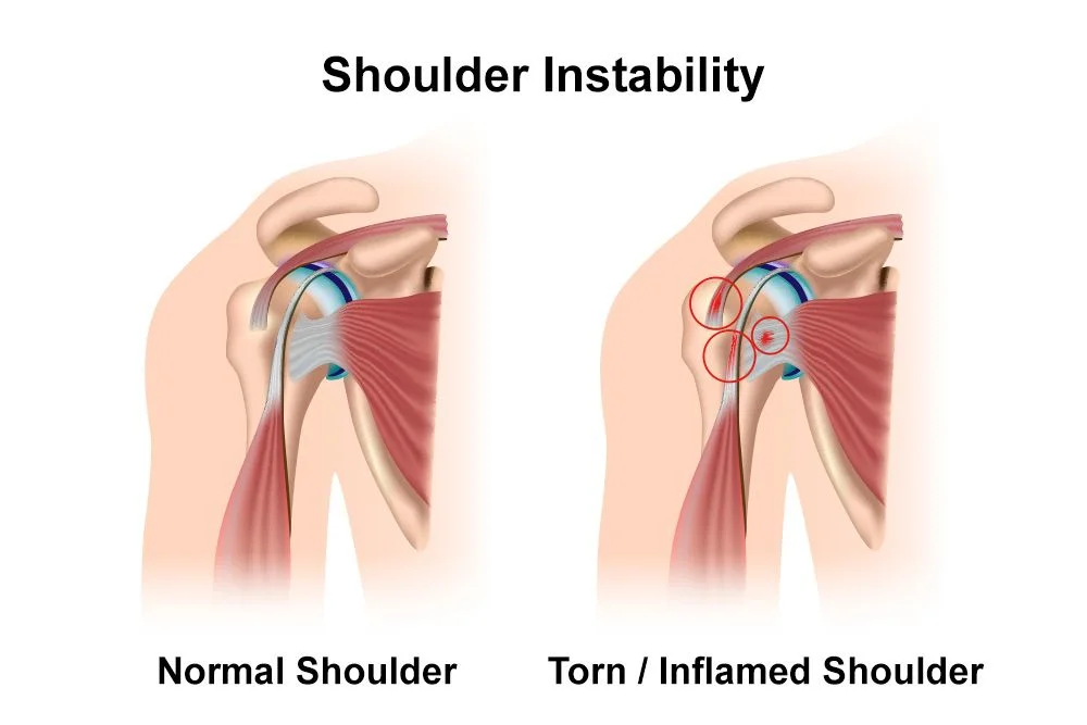 Illustration comparing a normal shoulder with shoulder instability